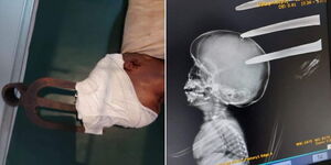 A collage of the child who was admitted at KNH hospital with a garden fork in his head.jpg