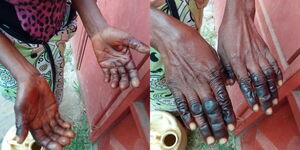 A photo collage of a woman's with bulged fingers after alleged subjection to inappropriate working conditions in Kilifi County. 