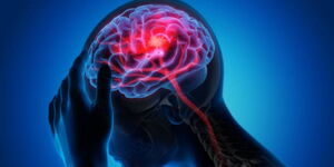 A photo illustration of how a stroke