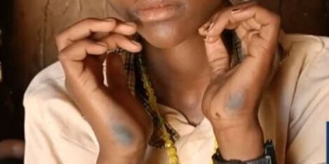A photo collage of Grade Seven Pupil Christine Ekusi displays blisters on her palms at her home in Lodwar .jpg