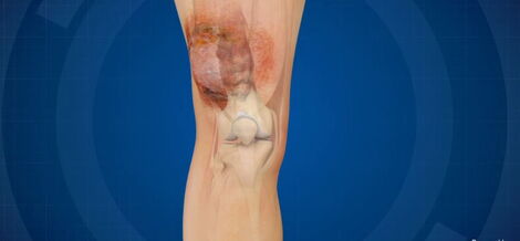 An illustration of a leg that has undergone Limb-Salvage surgery.