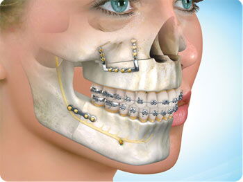 A representation of the correction following a maxillofacial surgery