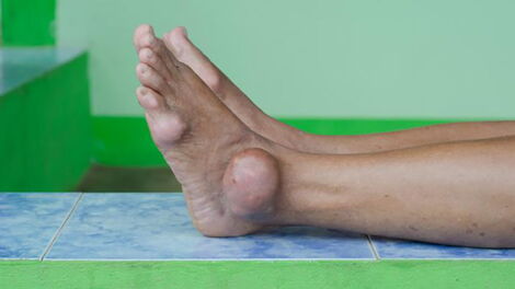 Gout patients often have acute inflammation around their joints.