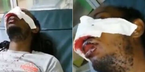 Samuel Maina lies at KNH after he was reportedly assaulted by police officers on Saturday, May 23, 2020